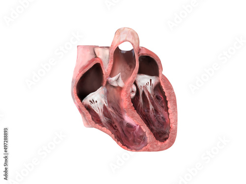 Billede på lærred heart anatomy, Left ventricular aneurysm, wall bulge, transmural damage, aneurys