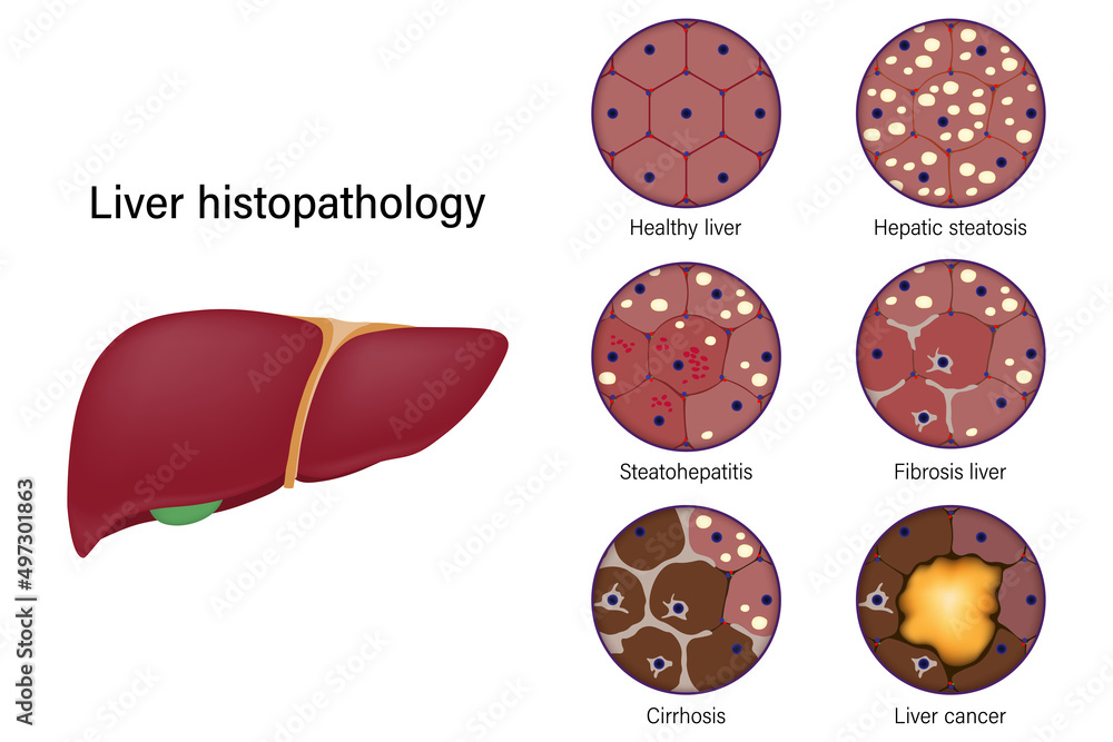 Liver histopathology. Healthy liver, Hepatic steatosis, Steatohepatitis