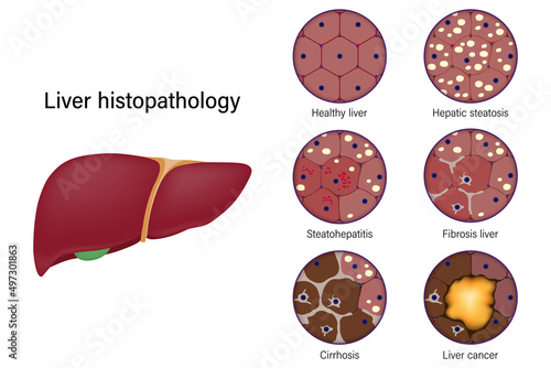 Liver histopathology. Healthy liver, Hepatic steatosis, Steatohepatitis, Fibrosis liver, Cirrhosis and Liver cancer.