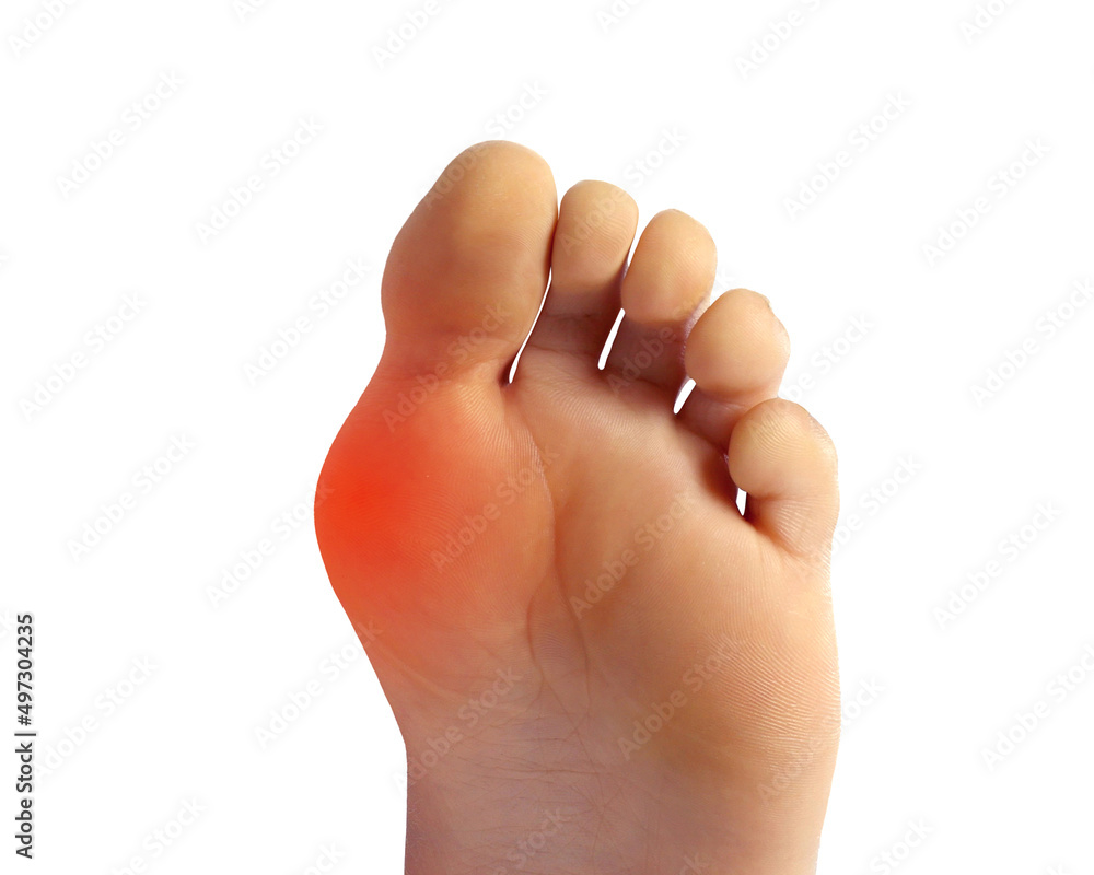 Foot pain in woman, the foot develop a bump on the outside of the foot