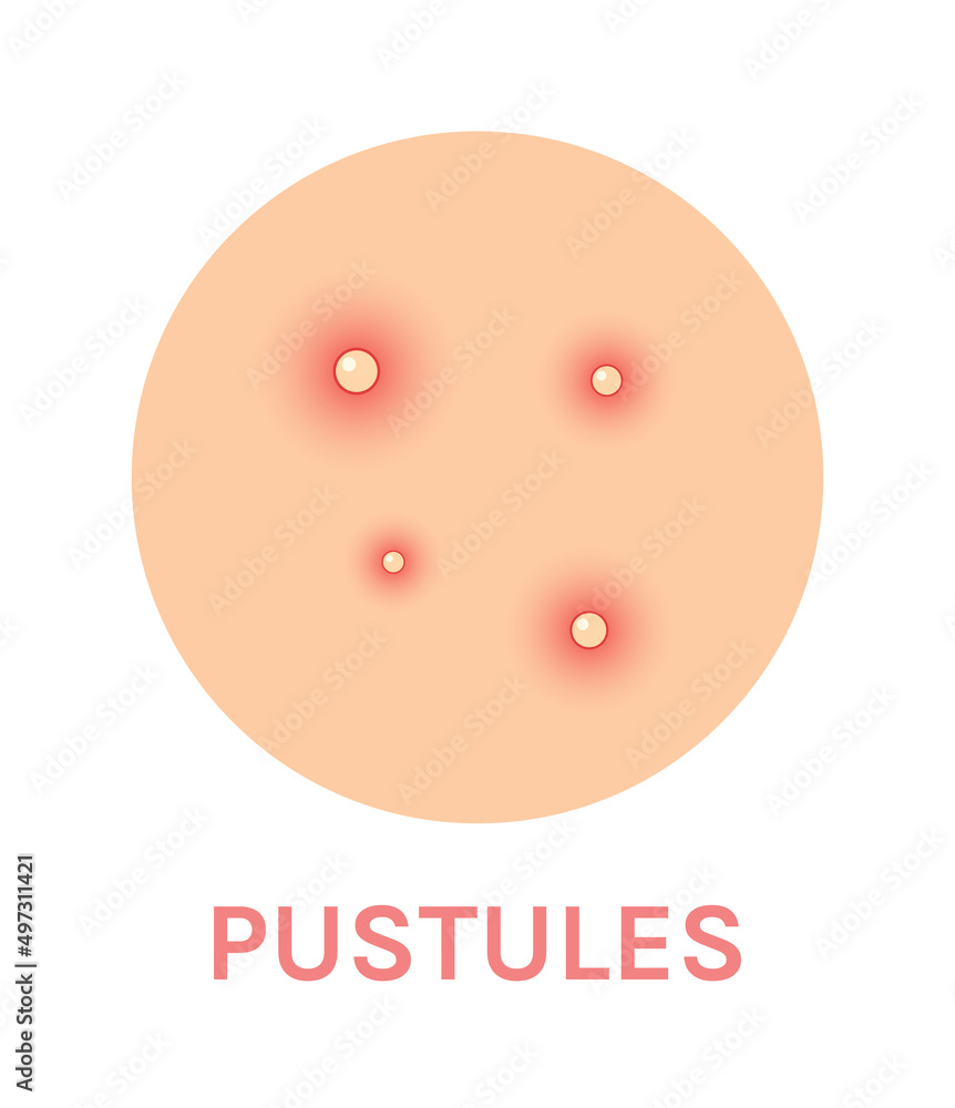Obraz premium Pustules. Problem Skin with a Red Rash. Close Up view of Acne and Pimples. Color Realistic Icon. Zoom. White background. Vector illustration for Medical and Beauty design.