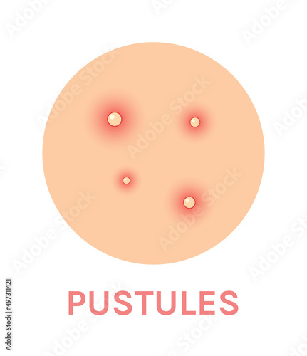 Pustules. Problem Skin with a Red Rash. Close Up view of Acne and Pimples. Color Realistic Icon. Zoom. White background. Vector illustration for Medical and Beauty design.
