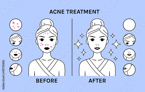 Woman with Pimples on Beautiful Face. Acne Treatment. Skin Problems. Before After. Clean skin and Happy Girl. Icons. Zoom. Flat Cartoon Line style. Vector illustration for Beauty and Medical design.