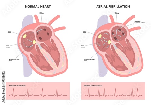 Atrial fibrillation minimally invasive procedure attack Cardiac catheter ablation rhythm problem cath lab treat treatment Coronary x-ray Radio frequency Sinus Ventricular SVT ECG ICD Radiofrequency AV