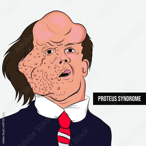 Proteus Syndrome is a congenital disease that causes excessive skin growth and abnormal development of bones, muscles, adipose tissue, blood vessels, and lymphatics.