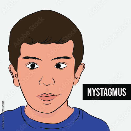 Nystagmus syndrome, involuntary movement of the eye that can make the eye move quickly from one side to another