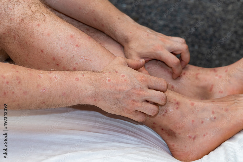 Bitten arms and legs by bloodthirsty insects in tropical countries, Scratching itchy spots, Vacation health problems with mosquitoes and sundfly