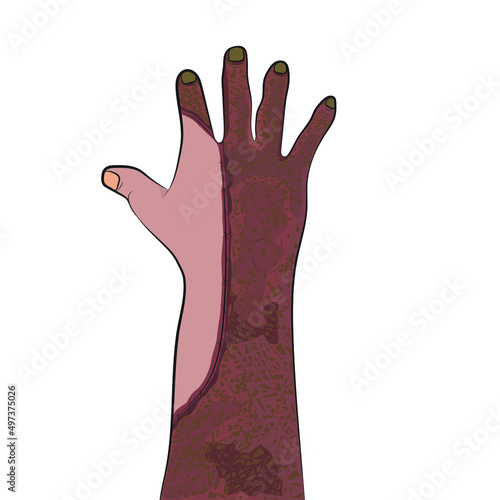 Burned right hand, fourth degree burn epidermis vector.