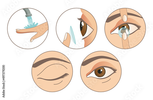 Contact lenses. Instruction how to use contact lenses. 6 steps. Wash your hands, take a lens, check the position of the lens. Carefully insert the lens