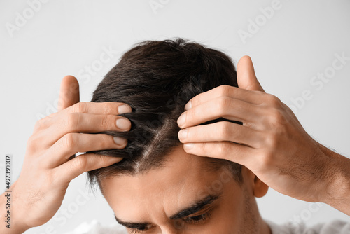 Handsome brunette man with hair loss problem on light background, closeup