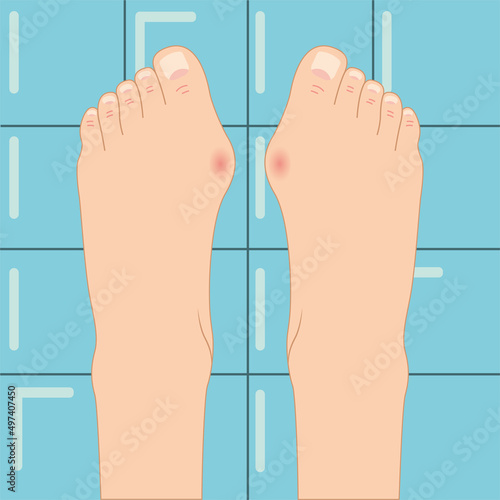 vector illustration. feet with crooked toes. feet with bunions. 