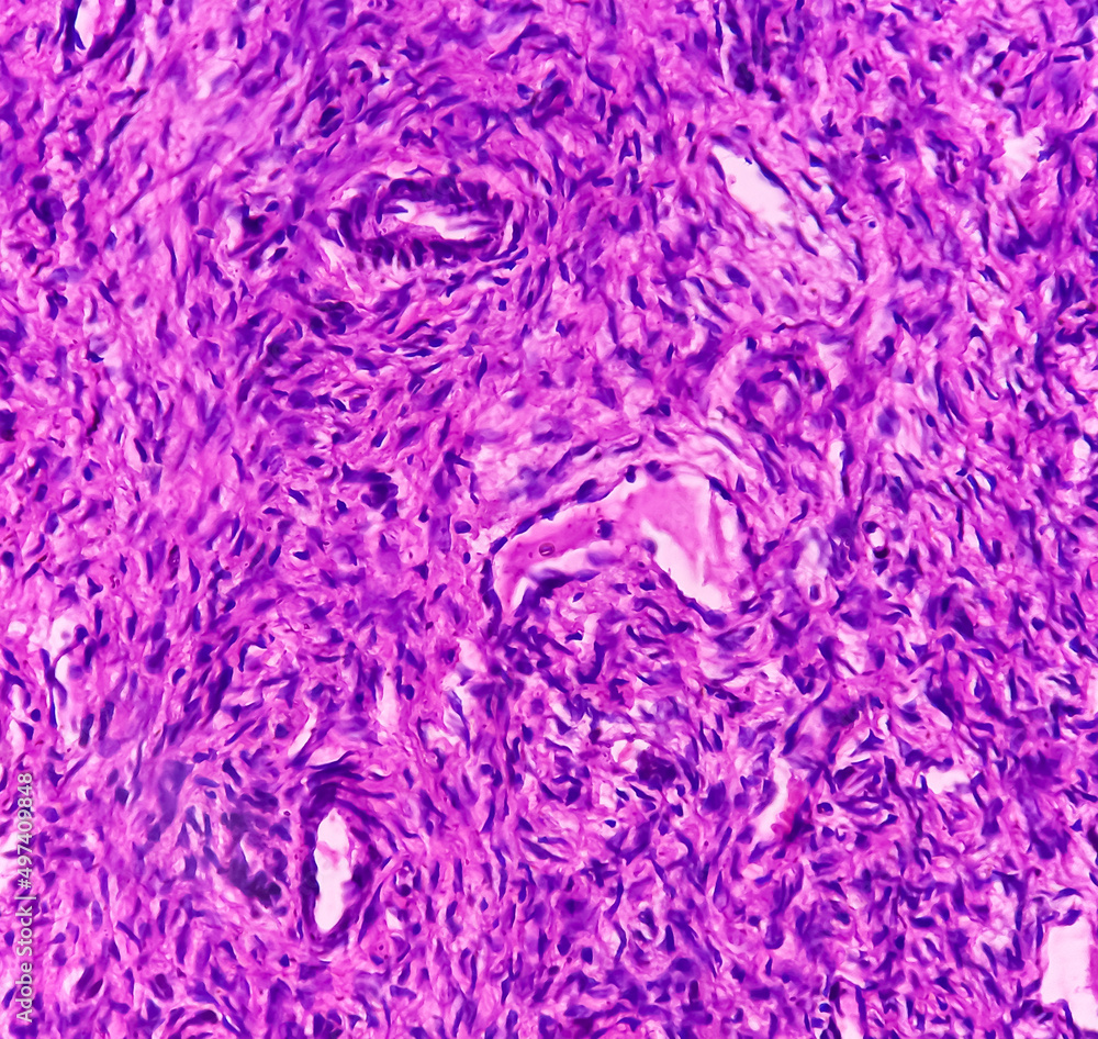 Ovarian cyst(biopsy) Mucinous cystadenoma, a benign tumor of ovary