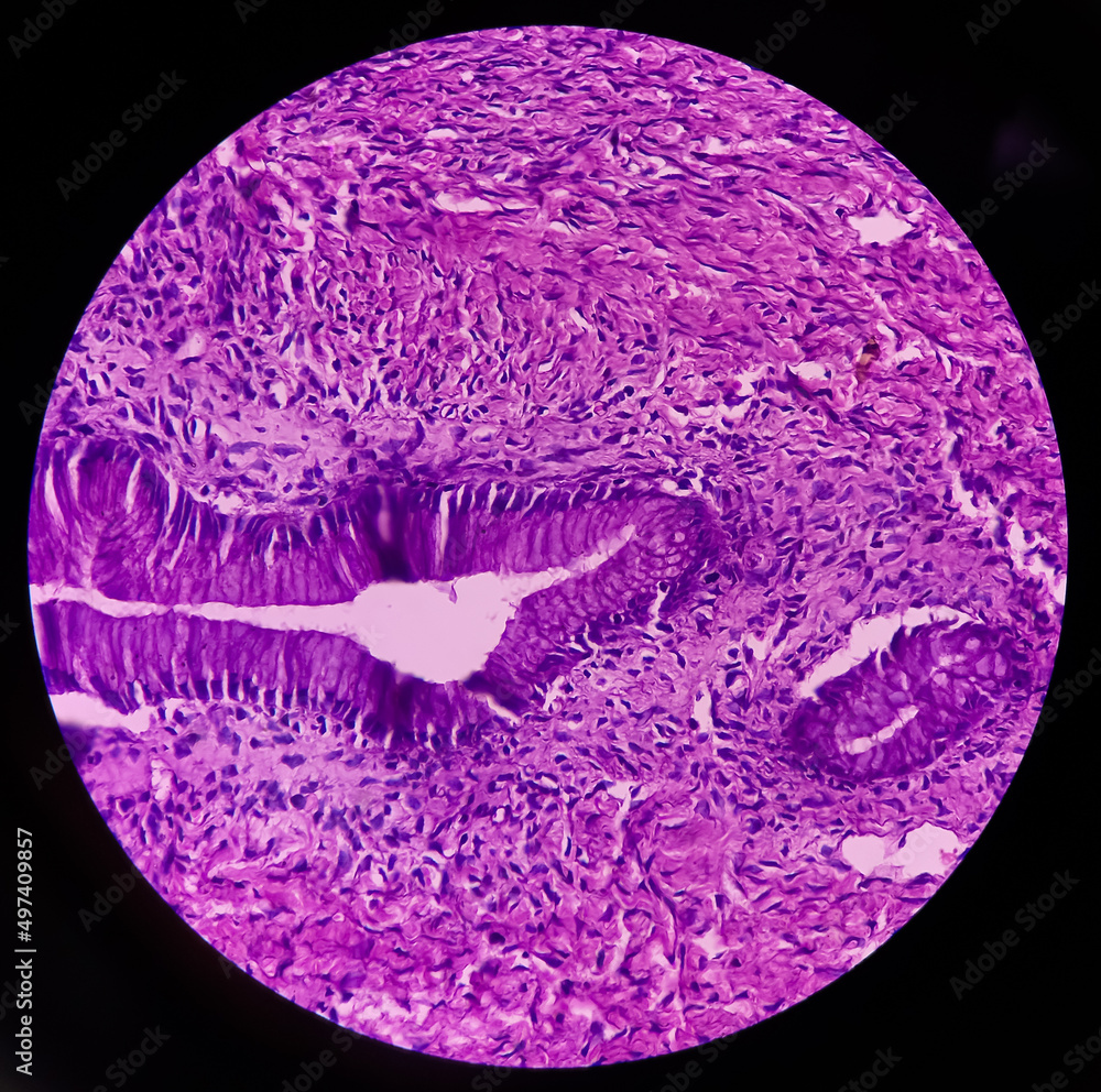 Ovarian cyst(biopsy) Mucinous cystadenoma, a benign tumor of ovary