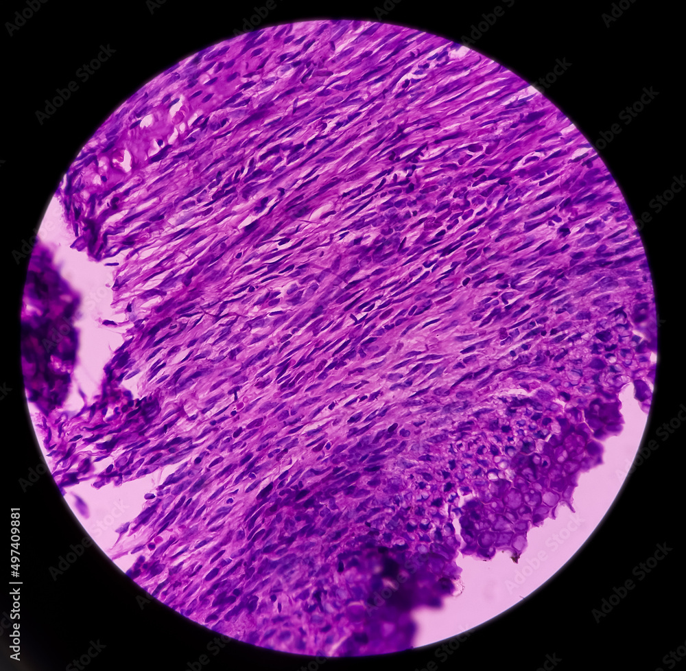 Ovarian cyst(biopsy) Mucinous cystadenoma, a benign tumor of ovary