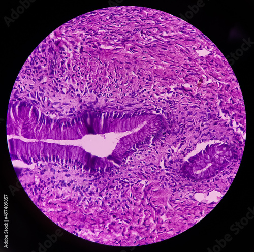 Ovarian cyst(biopsy): Mucinous cystadenoma, a benign tumor of ovary, ovarian cyst wall show fibrocollagenous tissue, single layer of columner cell with apical mucin. photo