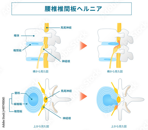 椎間板ヘルニアの図解イラスト