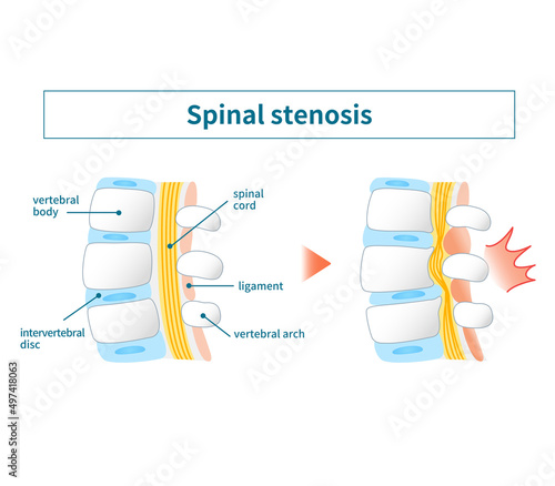 Illustration of lumbar spinal canal stenosis