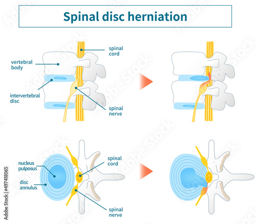 Illustration of lumbar disc herniation