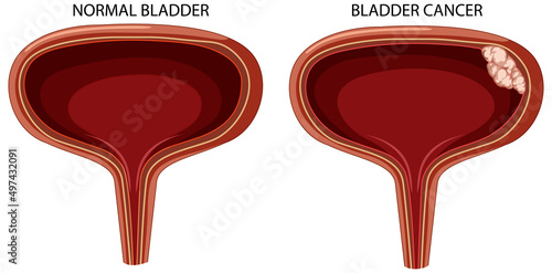 Stage of bladder cancer