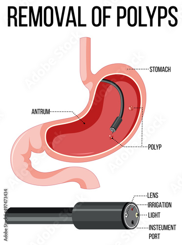 Diagram showing removal of polyps