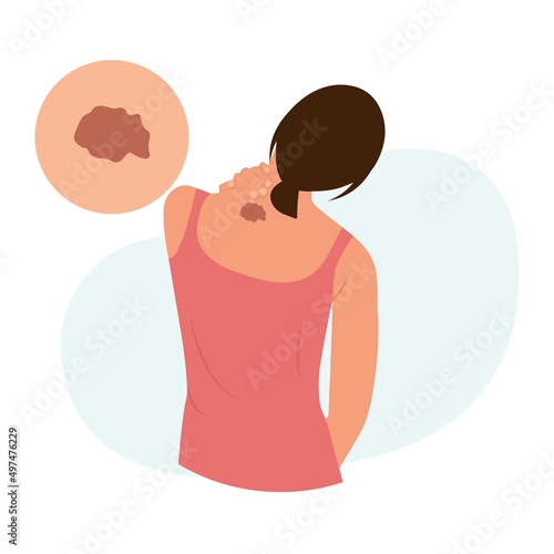Woman with  dark brown pigment spot on skin. Melanoma, dermatology, mole screening, birthmark. Dermatology, cosmetology concept.World Melanoma Day. Vector illustration