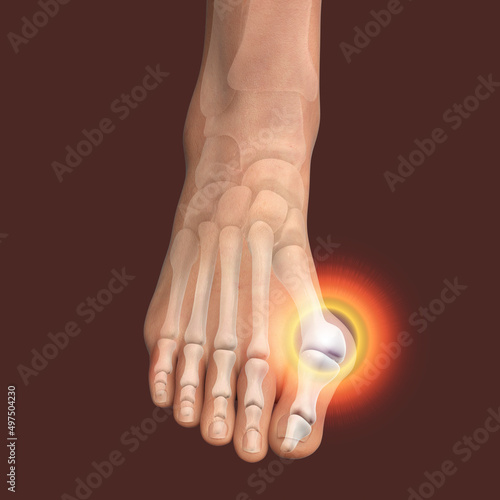 Toe deformation, also known as hallux valgus, or bunion photo