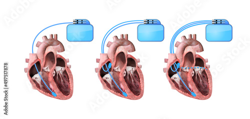 heart and cardiac pacemaker on white background 3d render, heart anatomy, section, right and left ventricle, atria, valves photo