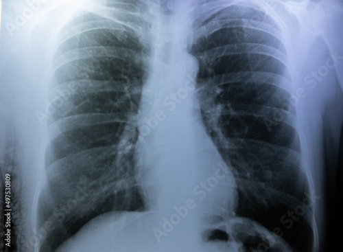 x ray image of a chest