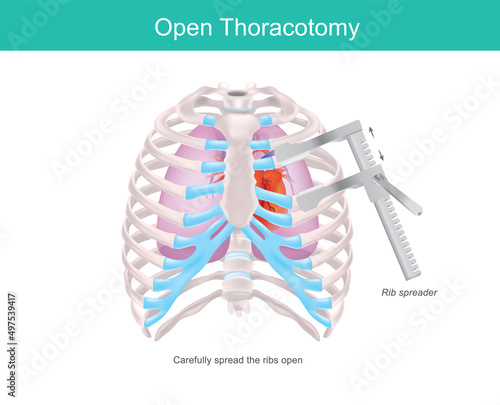 Open Thoracotomy. A procedure to gain access into the pleural space of the human chest by medical tool called Rib spreader. .