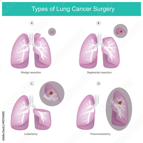 Types of Lung Cancer Surgery. Illustration the lung 4 types surgery caused of cancer..
