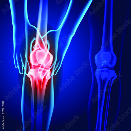X-ray image of two hands holding knee showing knee joint injury on dark blue background. Used in medical and educational fields.