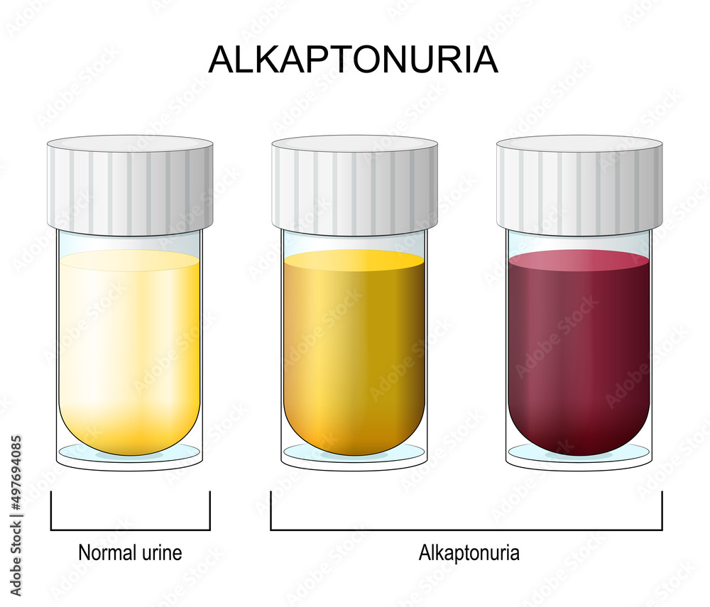 Alkaptonuria. Laboratory flasks with urine. Alkaptonuria. Laboratory flasks with urine.