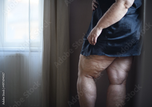 Bild auf Leinwand Fat woman with cellulite on her legs, cut out.