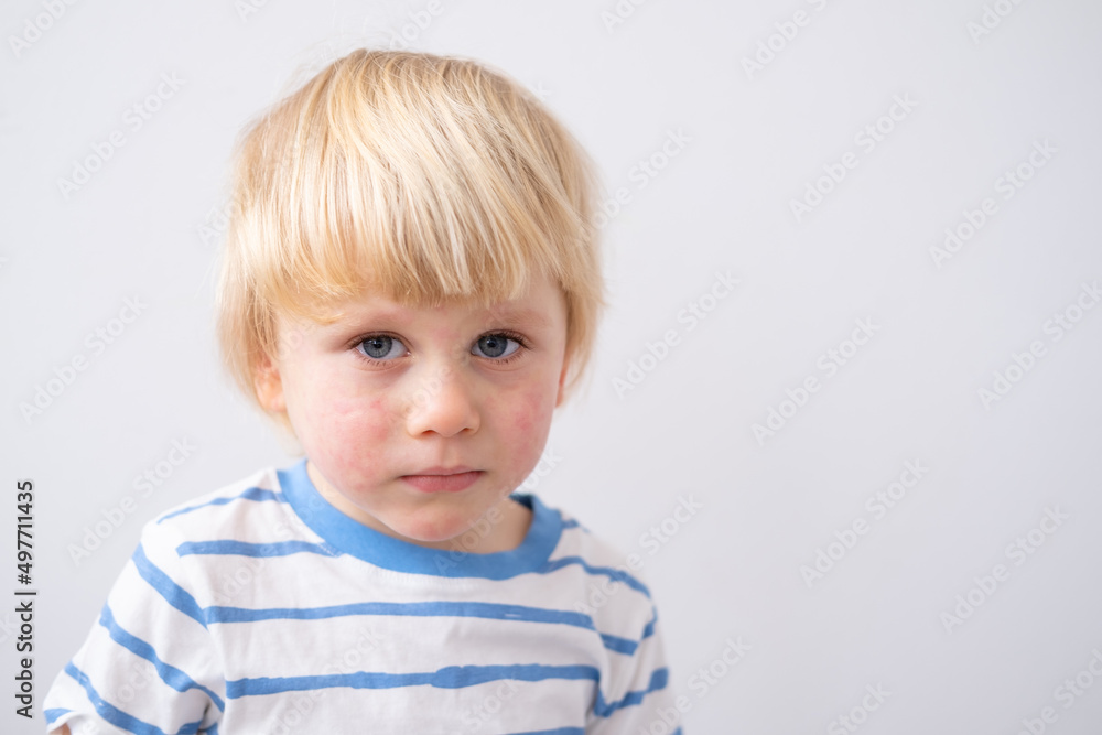 portrait of little boy with allergic rash or eczema on face. severe allergic reaction, atopic skin portrait of little boy with allergic rash or eczema on face. severe allergic reaction, atopic skin
