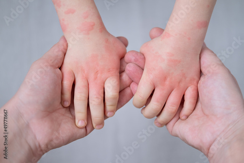 close up mother holding kids hands with allergic rash or eczema. severe allergic reaction, atopic skin