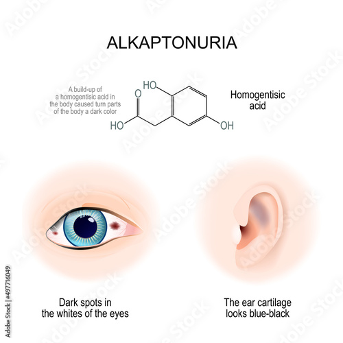 Alkaptonuria. sign and symptoms