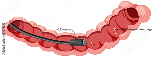 Diagram showing inside colon with colonoscope