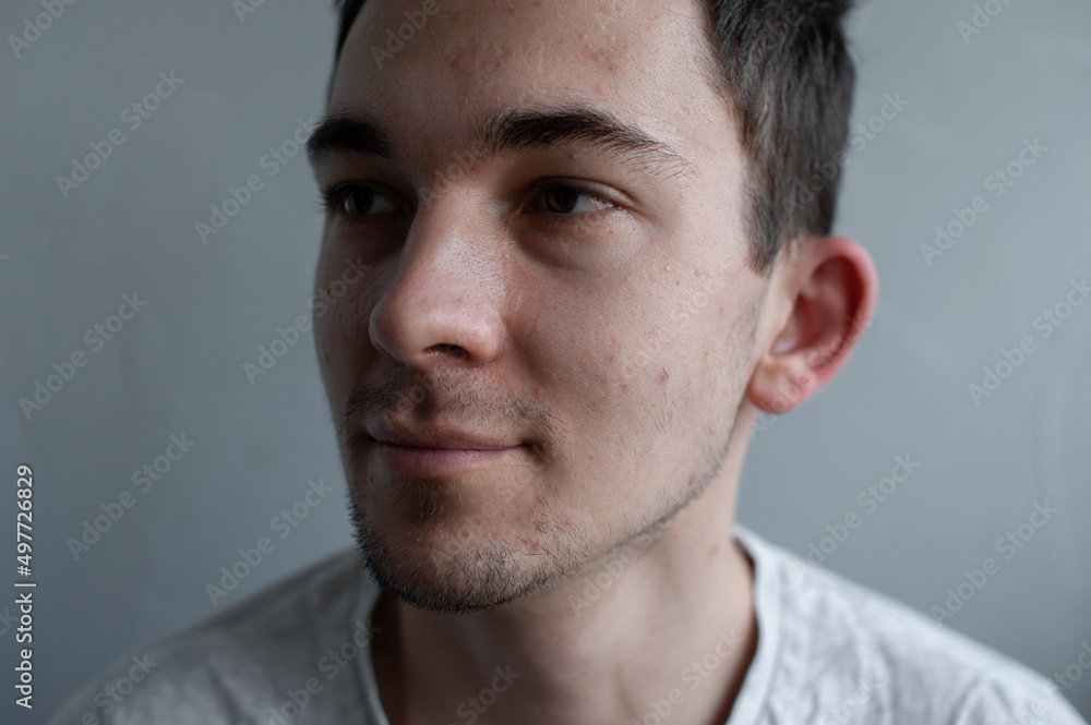Young man struggling with acne on his face caring for his skin pushes acne Young man struggling with acne on his face caring for his skin pushes acne