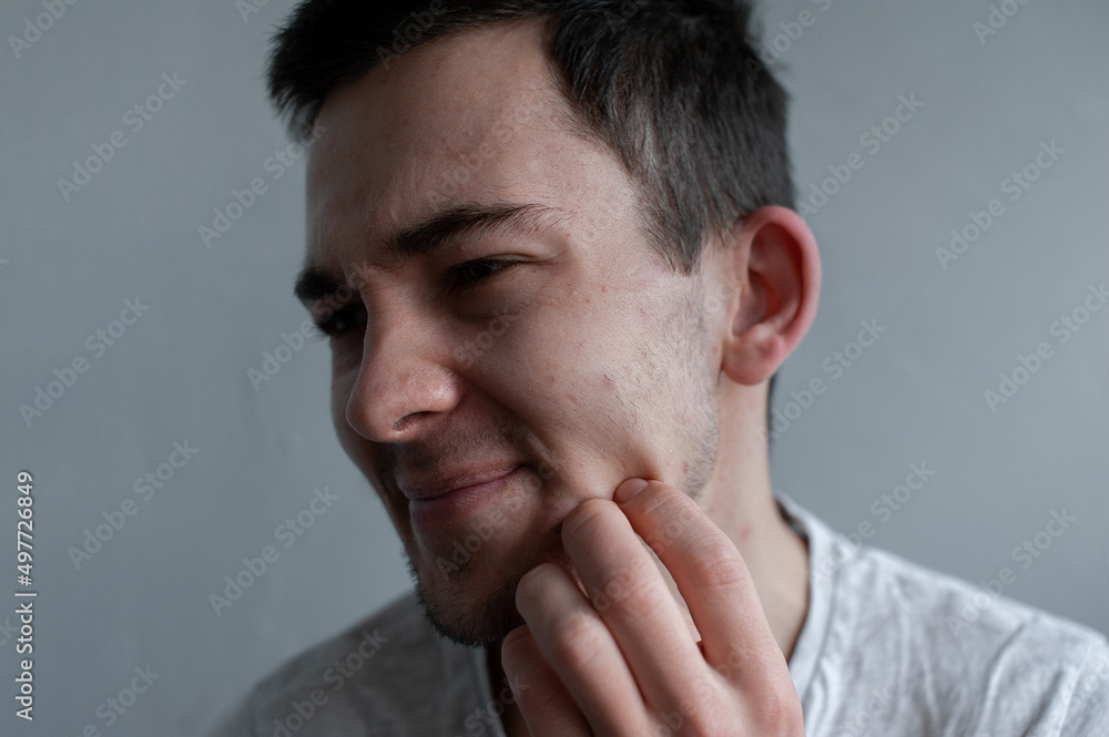 Young man struggling with acne on his face caring for his skin pushes acne Young man struggling with acne on his face caring for his skin pushes acne