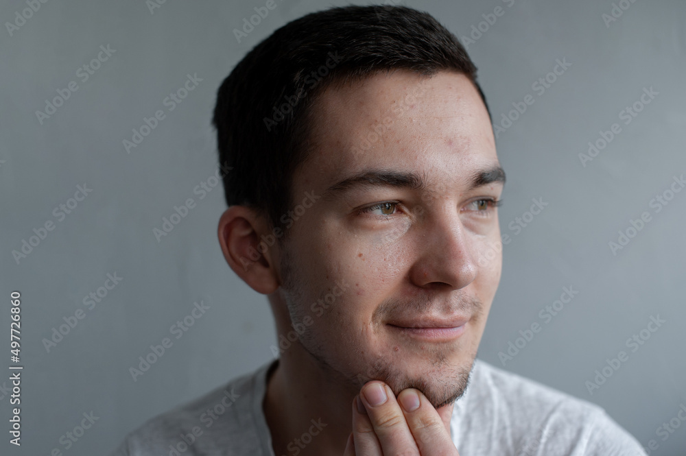 Young man struggling with acne on his face caring for his skin pushes acne Young man struggling with acne on his face caring for his skin pushes acne