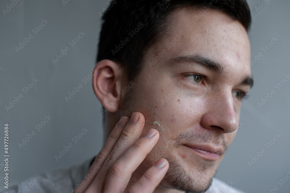 Obraz premium Young man struggling with acne on his face caring for his skin pushes acne applies a moisturizing cream mask of green color on the face 