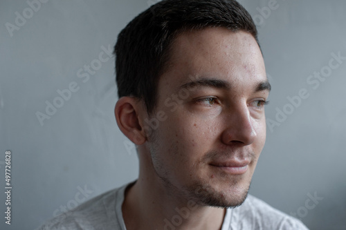 Young man struggling with acne on his face caring for his skin pushes acne