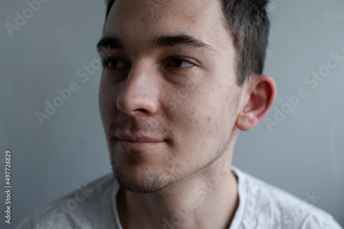 Young man struggling with acne on his face caring for his skin pushes acne