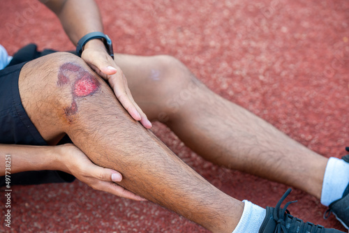 Принти на полотні Male leg with large wound because of a fall while jogging in the outdoors