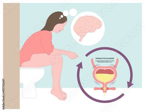 urge pass urine of pelvic floor muscle frequently Bed wetting toilet urination older nerve brain spasm tract tumor cancer stroke stress atonic Benign Lower Often leak anuria Neural Cystitis cord