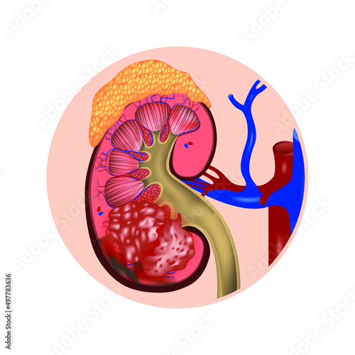 Kidney in section with a cancerous tumor and adrenal gland. Vector realistic icon