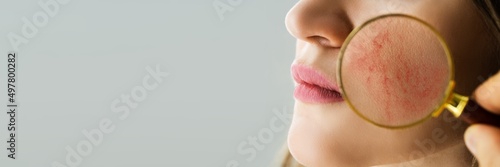 Obraz na plátně Examining Face Skin With Rosacea Problems