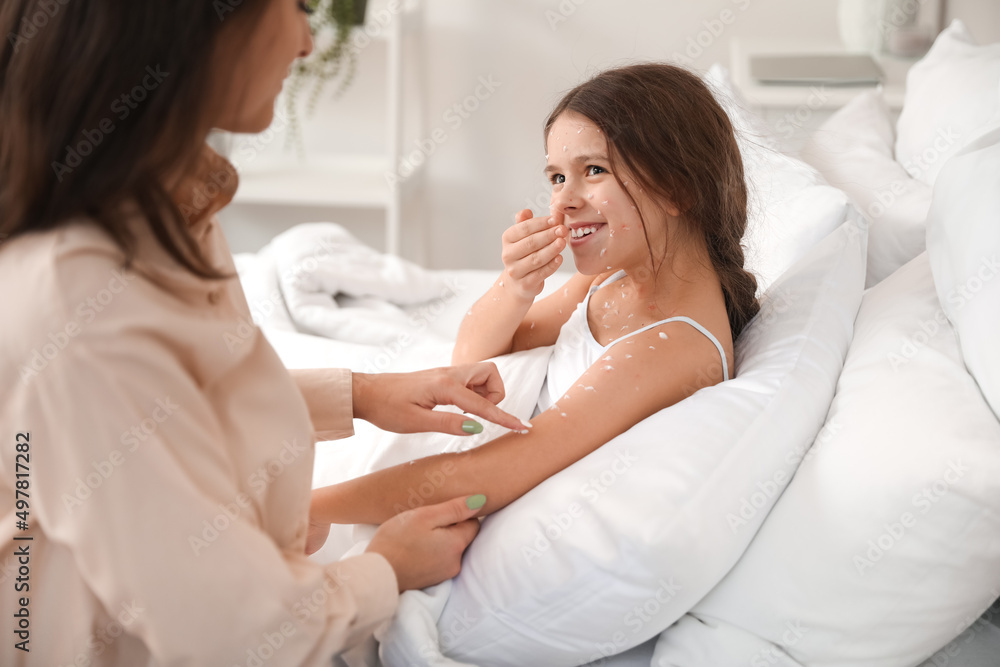 Mother applying remedy on skin of her little daughter ill with chickenpox at home Mother applying remedy on skin of her little daughter ill with chickenpox at home