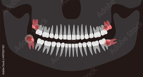 Human X-ray picture of teeth, vector illustration