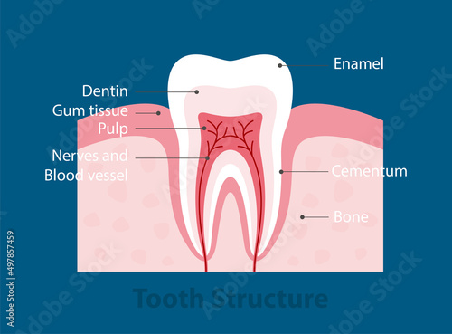 The stages of tooth decay, vector illustration